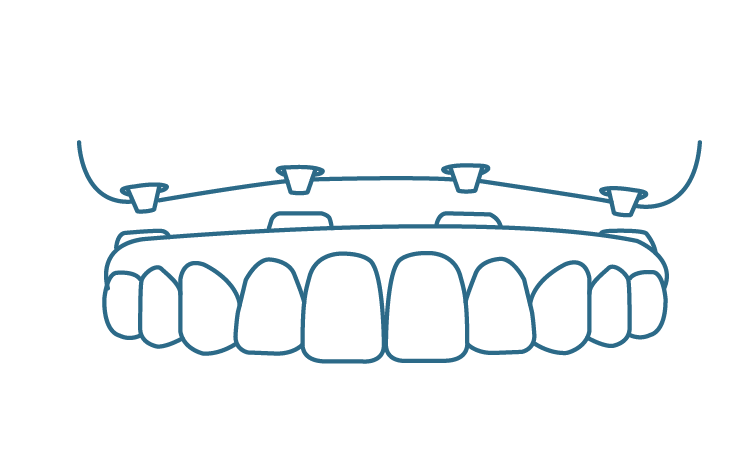 all-on-4-implants