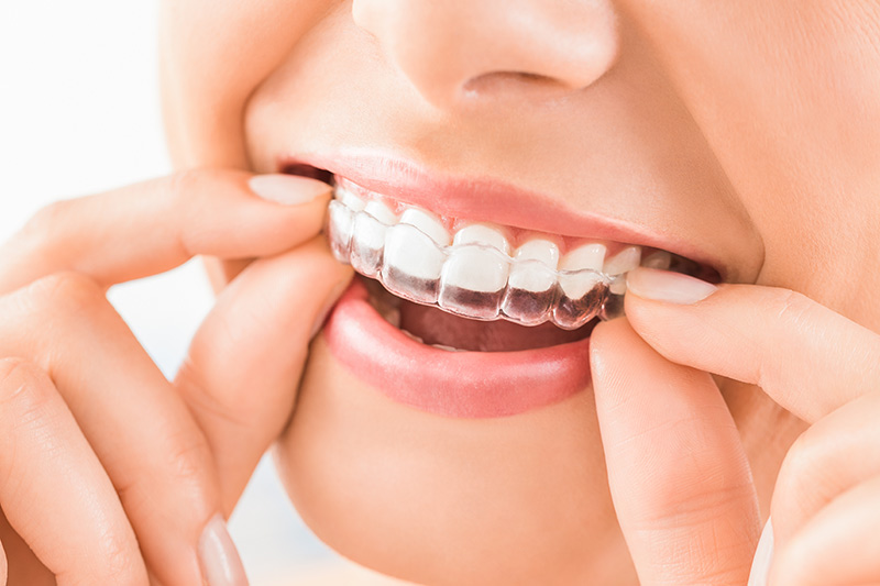 Crown Clinic London - Invisalign