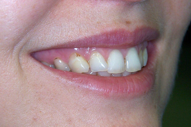 Crown Clinic London – Veneers Crown Clinic London - Veneers