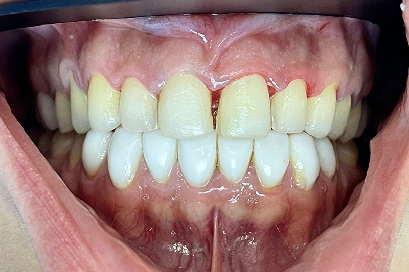 Crown Clinic London – Advanced Dental Treatment Crown Clinic London - Advanced Dental Treatment
