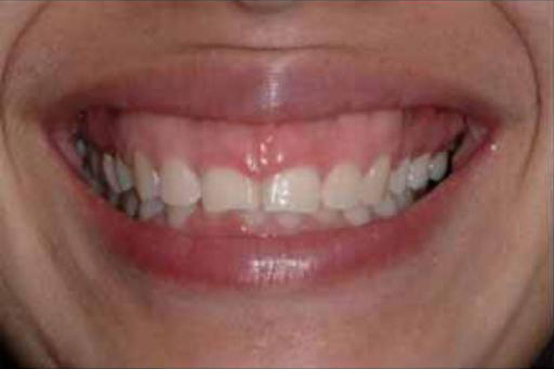 Crown Clinic London – Gummy Smile Surgery Crown Clinic London - Gummy Smile Surgery