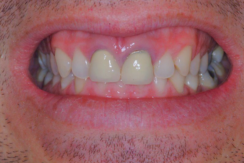 Crown Clinic London – Ceramic High Aesthetic Implants Crown Clinic London - Ceramic High Aesthetic Implants