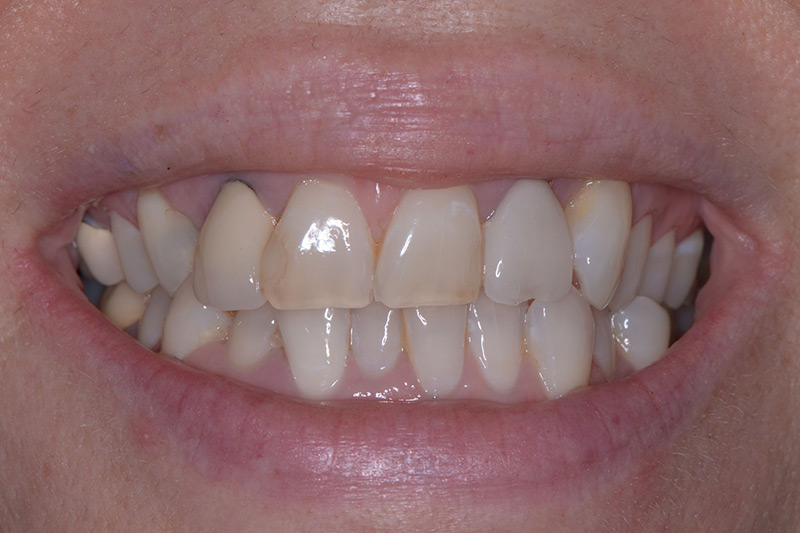 Crown Clinic London – Full Mouth Rehabilitation and Smile Design Crown Clinic London - Full Mouth Rehabilitation and Smile Design