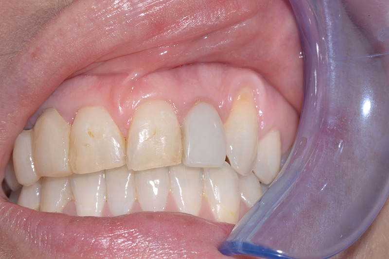 Crown Clinic London – Gum Grafting Crown Clinic London - Gum Grafting