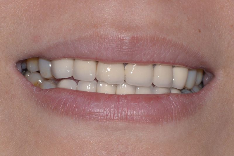Crown Clinic London – Change of old crowns Crown Clinic London - Change of old crowns