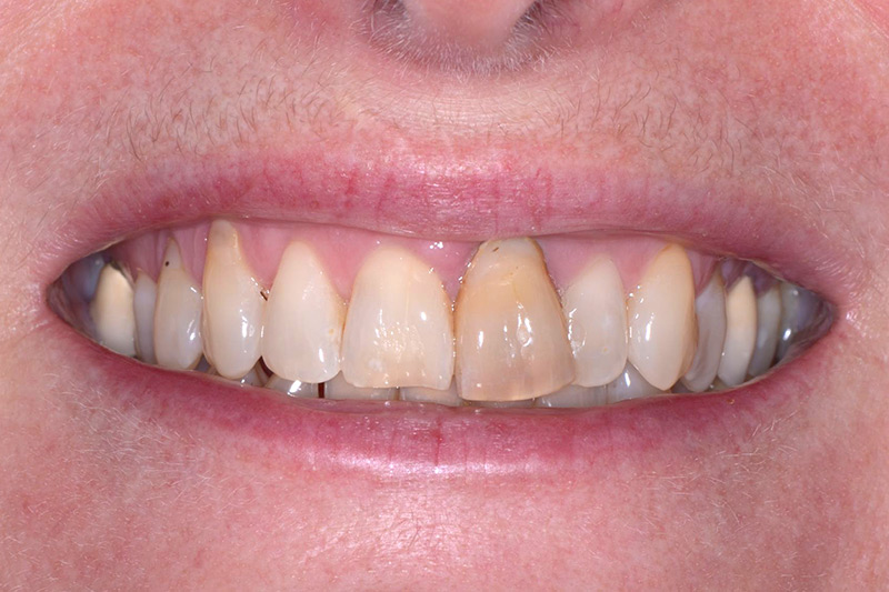 Crown Clinic London – Single Implant and Whitening Crown Clinic London - Single Implant and Whitening