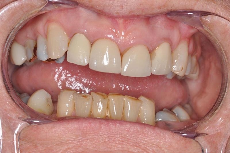 Crown Clinic London – Dento-Alveolar reconstruction Crown Clinic London - Dento-Alveolar reconstruction