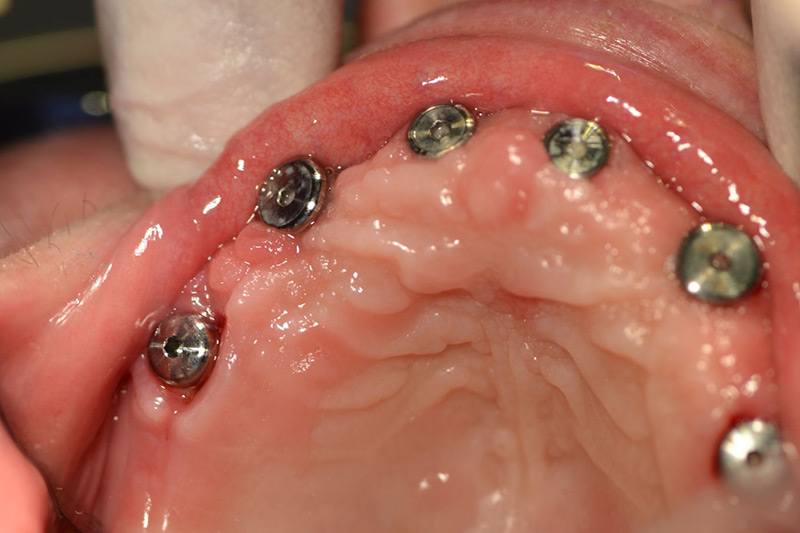 Crown Clinic London – Full Arch Implant in 6 Hours Crown Clinic London - Full Arch Implant in 6 Hours