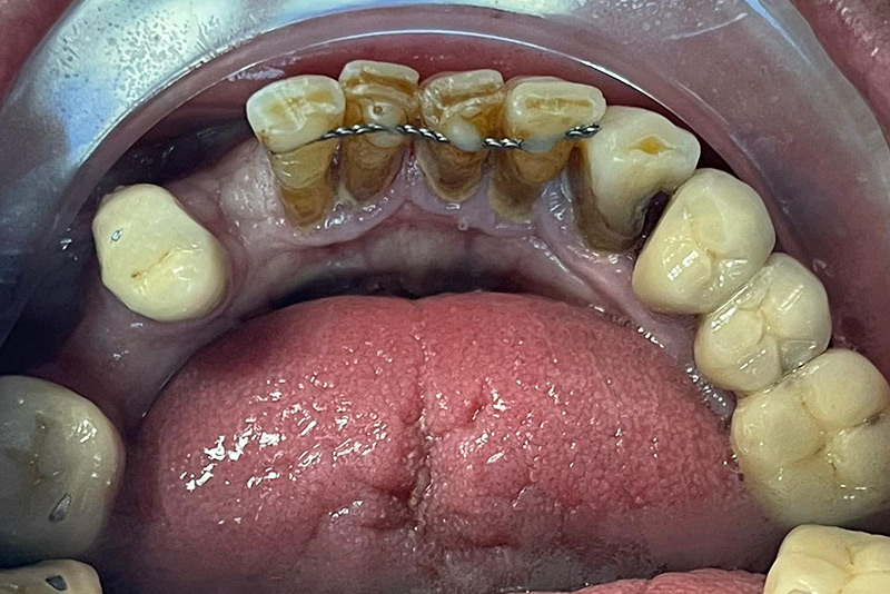 1Crown Clinic London – Same Day Dental Implants Crown Clinic London - Same Day Dental Implants