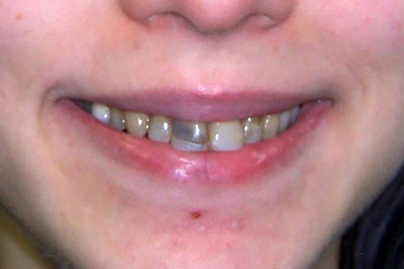 Crown Clinic London – Full Mouth Rehabilitation Crown Clinic London - Full Mouth Rehabilitation