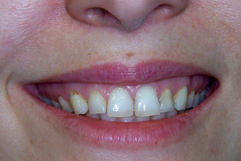 Crown Clinic London – Veneers Crown Clinic London - Veneers