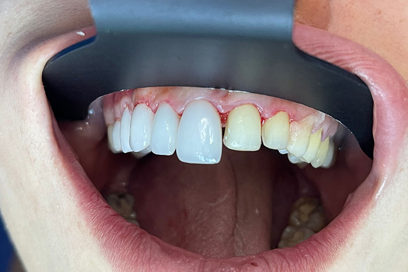 Crown Clinic London – Advanced Dental Treatment Crown Clinic London - Advanced Dental Treatment