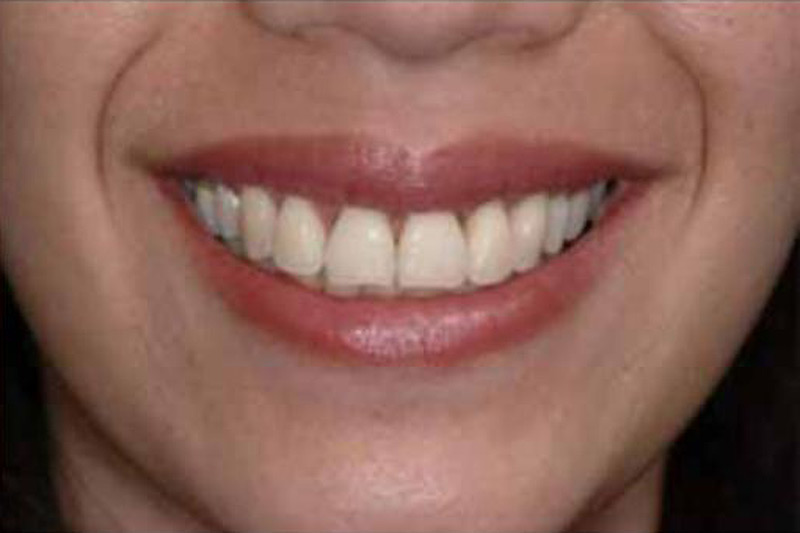 Crown Clinic London – Gummy Smile Surgery Crown Clinic London - Gummy Smile Surgery