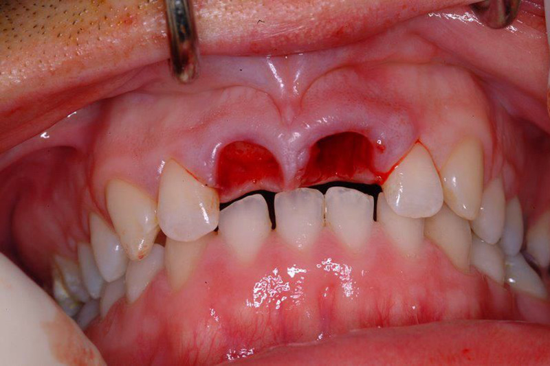 Crown Clinic London – Ceramic High Aesthetic Implants Crown Clinic London - Ceramic High Aesthetic Implants