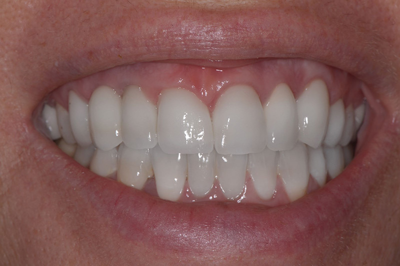Crown Clinic London – Full Mouth Rehabilitation and Smile Design Crown Clinic London - Full Mouth Rehabilitation and Smile Design