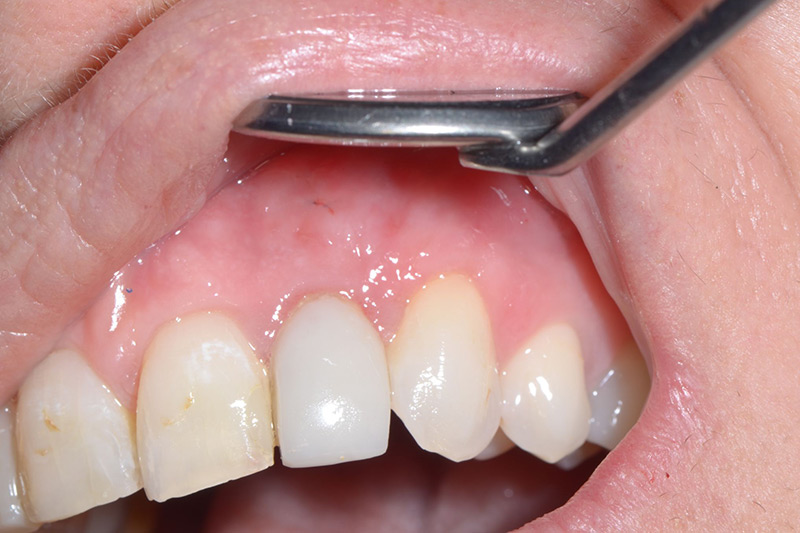 Crown Clinic London – Gum Grafting Crown Clinic London - Gum Grafting
