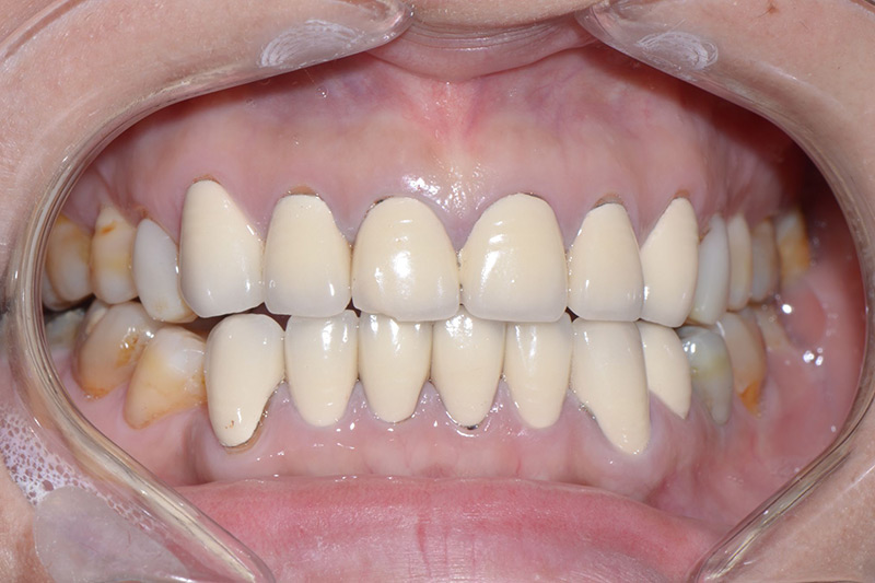 Crown Clinic London – Change of old crowns Crown Clinic London - Change of old crowns