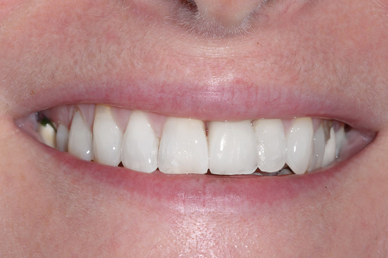 Crown Clinic London – Single Implant and Whitening Crown Clinic London - Single Implant and Whitening