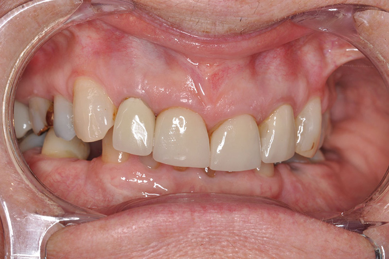 Crown Clinic London – Dento-Alveolar reconstruction Crown Clinic London - Dento-Alveolar reconstruction