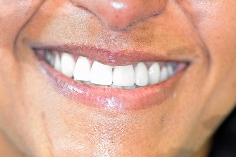 Crown Clinic London – Advanced Orthodontic Treatment Crown Clinic London - Advanced Orthodontic Treatment
