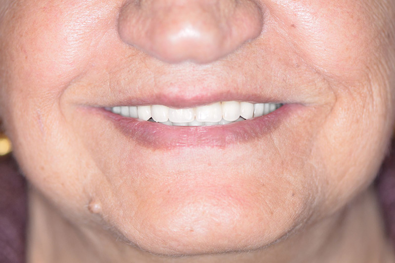 Crown Clinic London – Dental Face Lift Crown Clinic London - Dental Face Lift