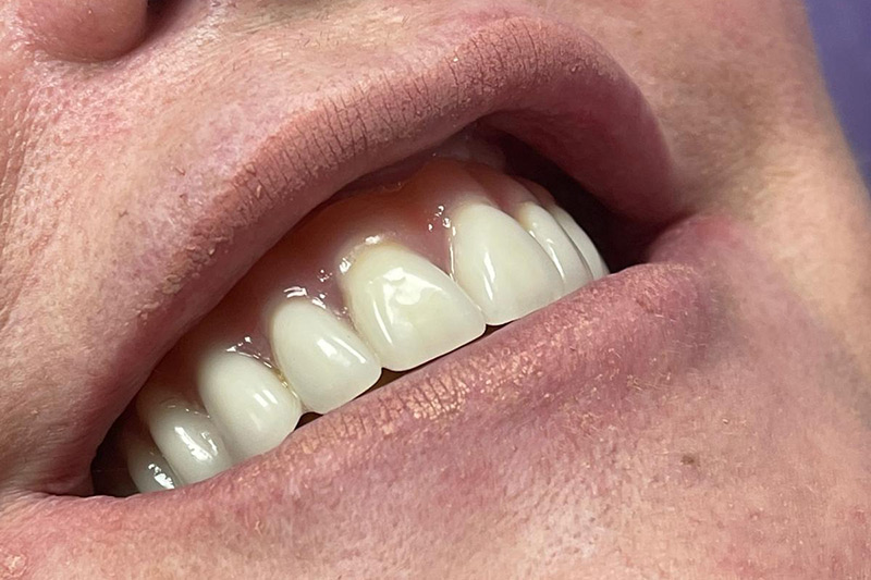 Crown Clinic London – Same Day Dental Implants Crown Clinic London - Same Day Dental Implants