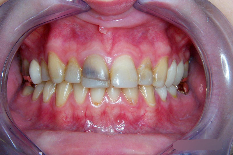 Crown Clinic London – Full Mouth Rehabilitation Crown Clinic London - Full Mouth Rehabilitation