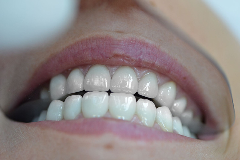 Crown Clinic London – Veneers Crown Clinic London - Veneers