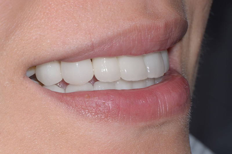 Crown Clinic London – Change of old crowns Crown Clinic London - Change of old crowns