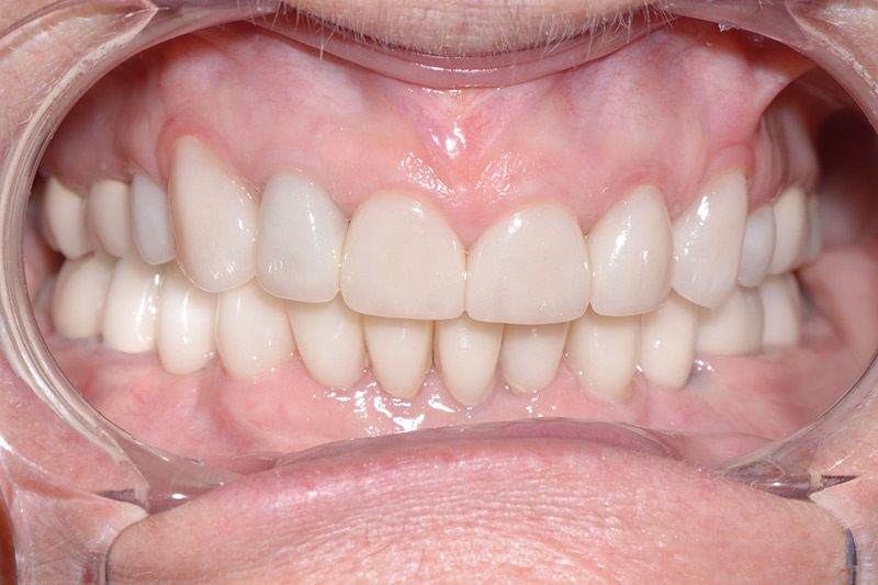 Crown Clinic London – Dento-Alveolar reconstruction Crown Clinic London - Dento-Alveolar reconstruction