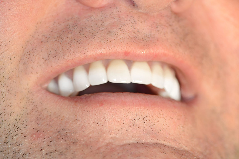 Crown Clinic London – Full Arch Implant in 6 Hours Crown Clinic London - Full Arch Implant in 6 Hours