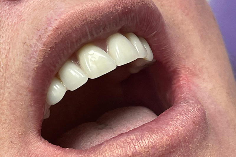 Crown Clinic London – Same Day Dental Implants Crown Clinic London - Same Day Dental Implants