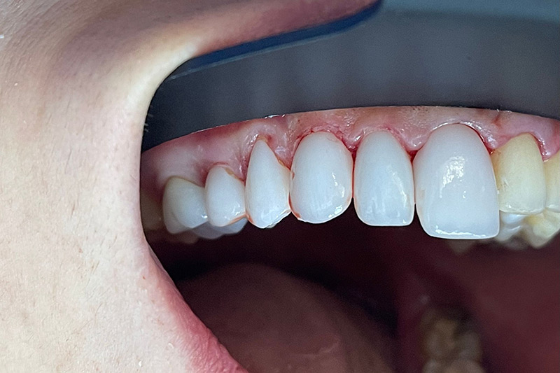 Crown Clinic London – Advanced Dental Treatment Crown Clinic London - Advanced Dental Treatment