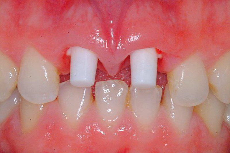 Crown Clinic London – Ceramic High Aesthetic Implants Crown Clinic London - Ceramic High Aesthetic Implants