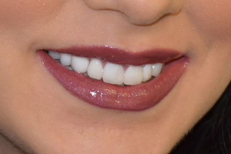 Crown Clinic London – Full Mouth Rehabilitation Crown Clinic London - Full Mouth Rehabilitation