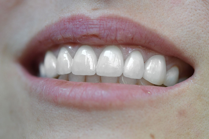 Crown Clinic London – Veneers Crown Clinic London - Veneers