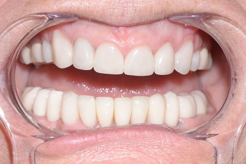 Crown Clinic London – Dento-Alveolar reconstruction Crown Clinic London - Dento-Alveolar reconstruction