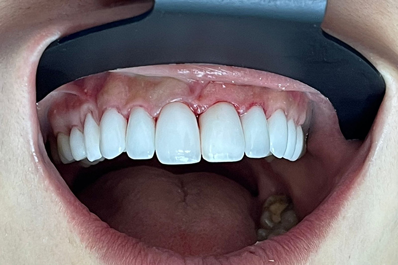 Crown Clinic London – Advanced Dental Treatment Crown Clinic London - Advanced Dental Treatment