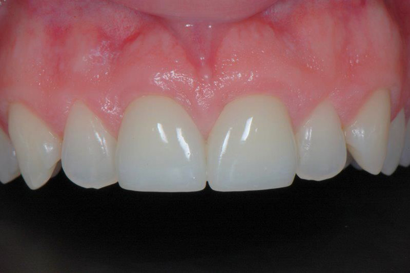 Crown Clinic London – Ceramic High Aesthetic Implants Crown Clinic London - Ceramic High Aesthetic Implants