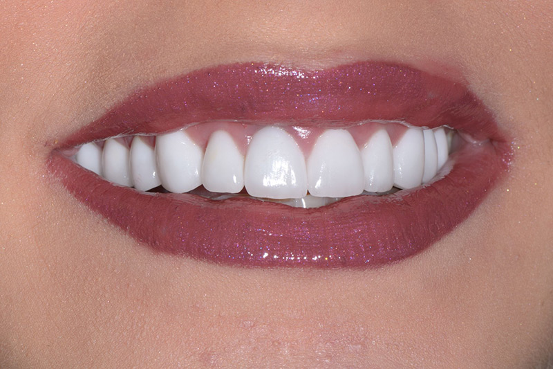 Crown Clinic London – Full Mouth Rehabilitation Crown Clinic London - Full Mouth Rehabilitation