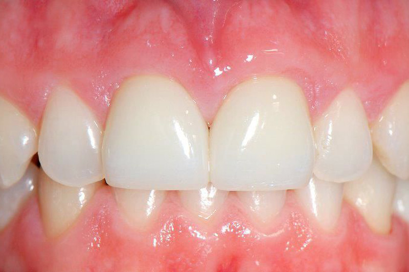 Crown Clinic London – Ceramic High Aesthetic Implants Crown Clinic London - Ceramic High Aesthetic Implants